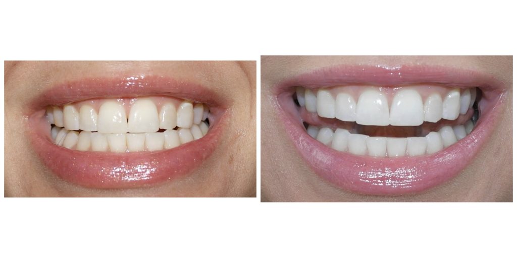 Before and After Smile Brilliant